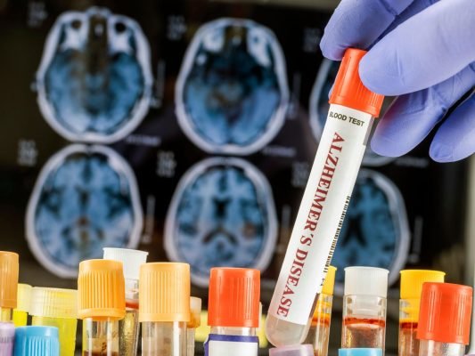 New Blood Test May Detect Alzheimer’s Before Symptoms Begin